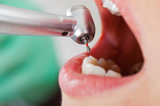 Best Knocked-Out Tooth (Avulsed Tooth) Treatment in Delta, CO